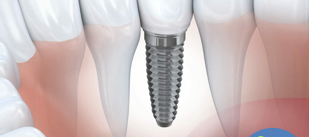 Mitos y falsedades sobre implantes dentales